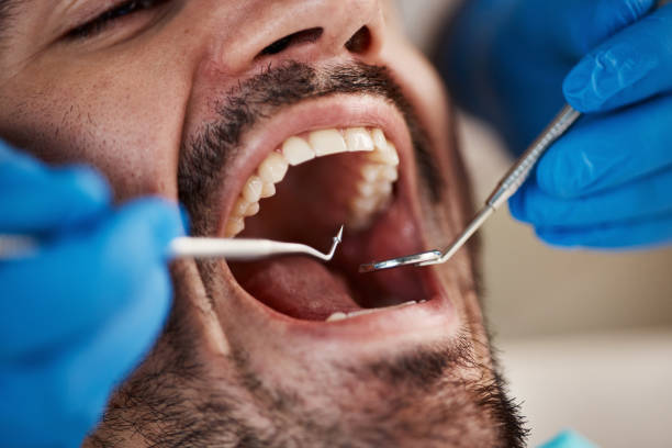 Best Emergency Dental Extractions in Broomall, PA
